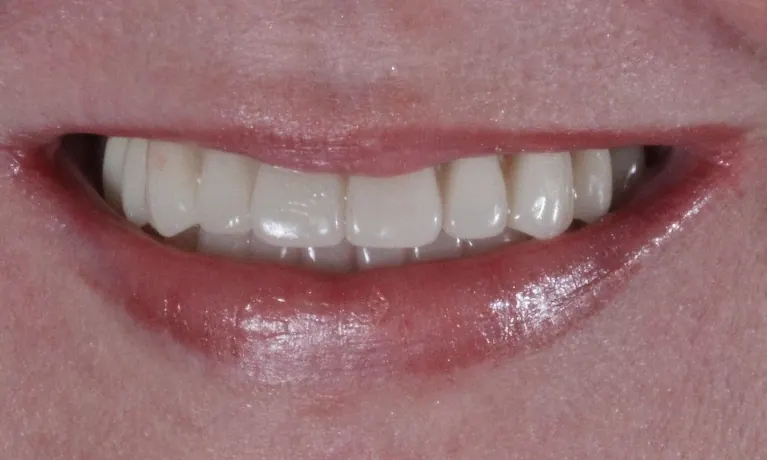 After: a full, even row of new upper teeth.