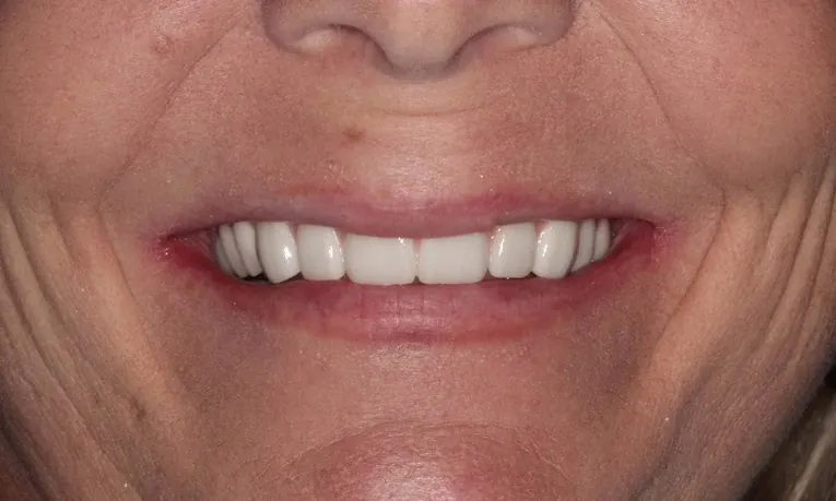 After: a fixed bridge of natural-looking teeth on implants.