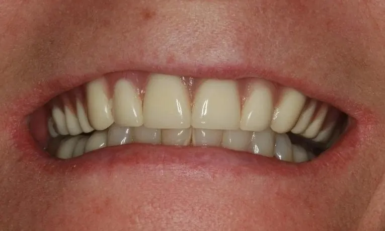 Before: long, uneven front teeth on a removable denture.