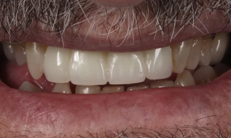 After: temporary teeth on the new implants filling the gap.