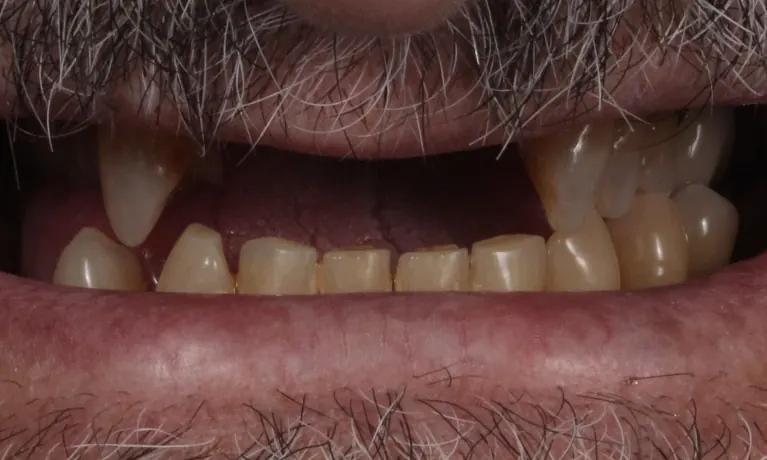 Before: a wide gap across the upper front teeth where the broken bridge was removed.
