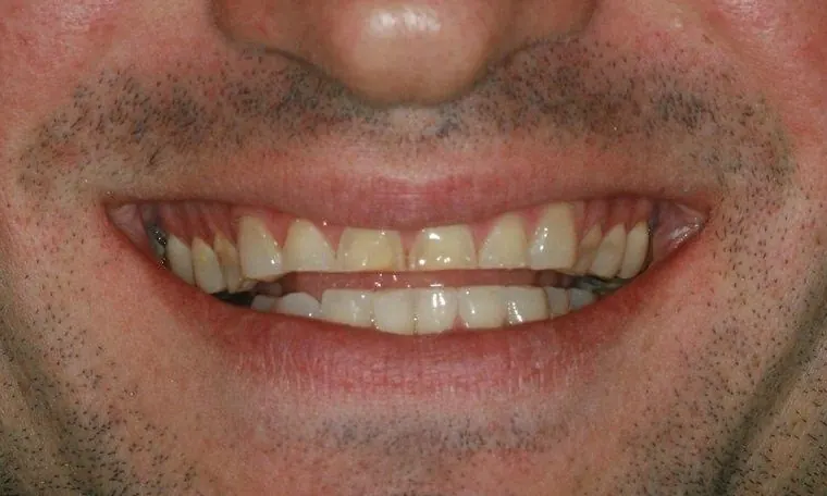 Before: short, worn and uneven upper teeth.