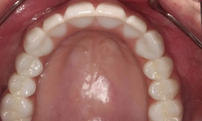 An upper arch of fixed replacement teeth supported by dental implants, seen from below.